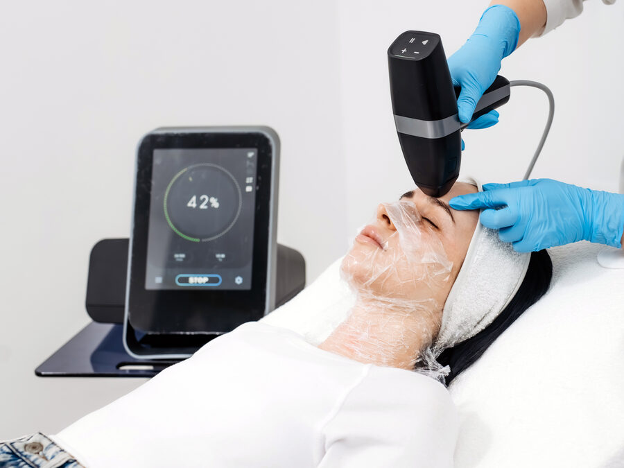 Microneedling with RF